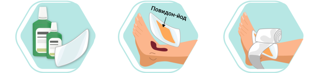 Пролежни: стадии, лечение, профилактика у лежачих больных