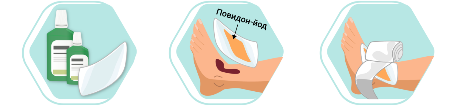 Пролежни: стадии, лечение, профилактика у лежачих больных
