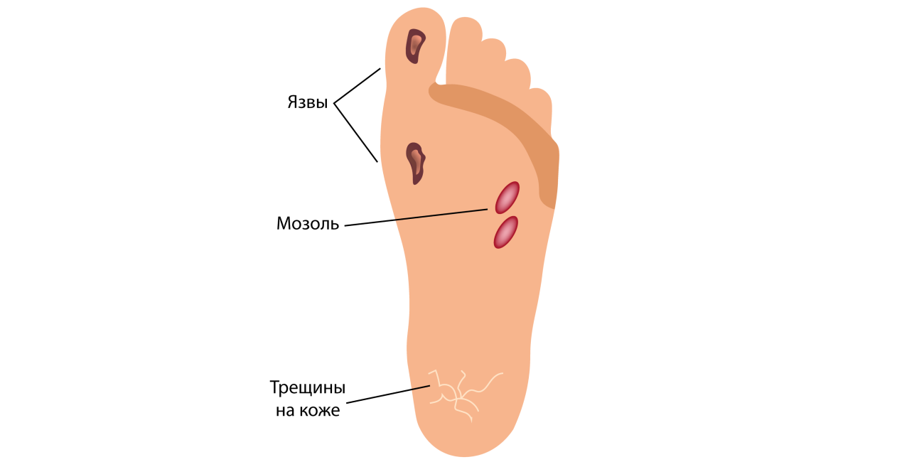 Язвы голени мкб 10. Трофические язвы между пальцами ног.