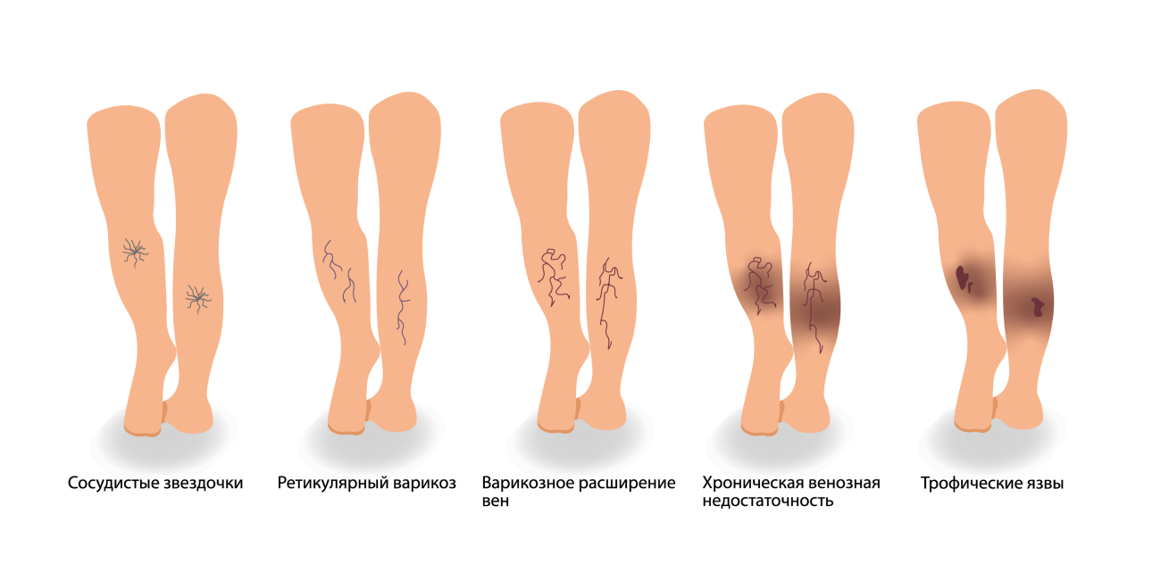 Трофические Язвы На Ногах Фото Лечение
