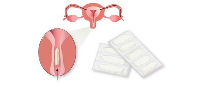 Молочница у женщин: причины, симптомы, лечение