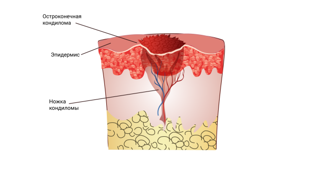 Аногенитальные бородавки