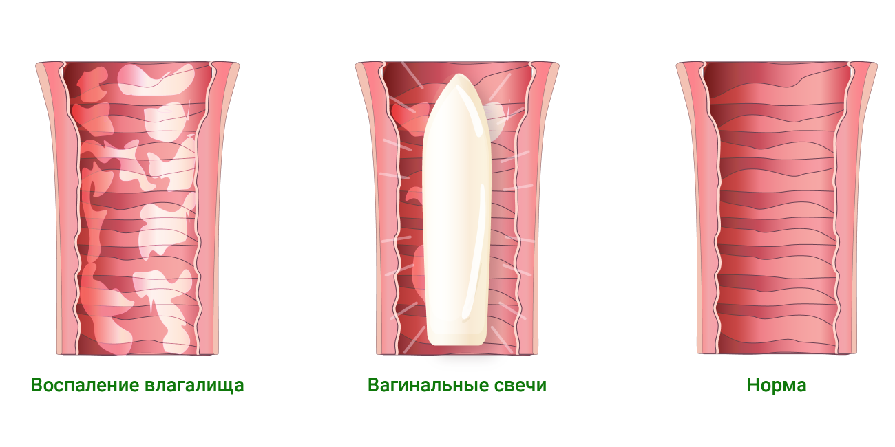 Как выглядит вагинит фото