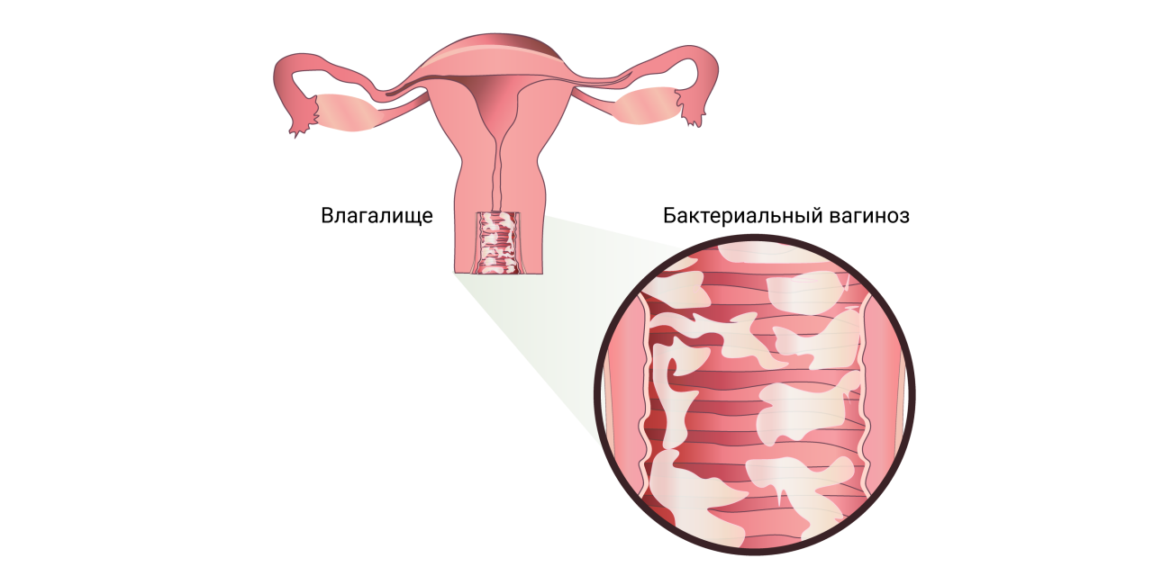 Бактериальный вагиноз картинки