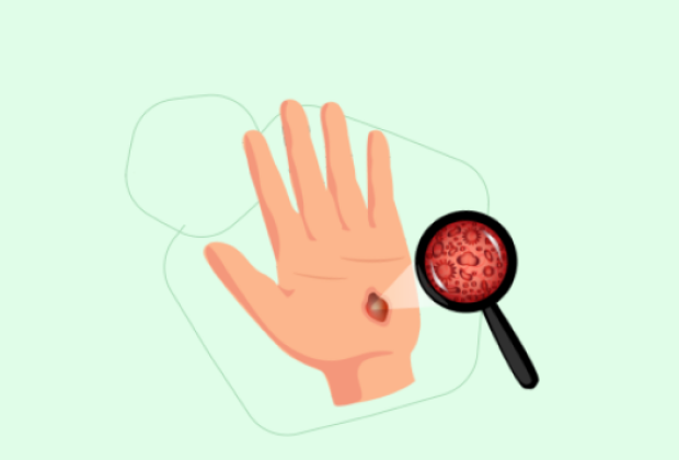 Термический ожог: оказание первой помощи, обработка и лечение.