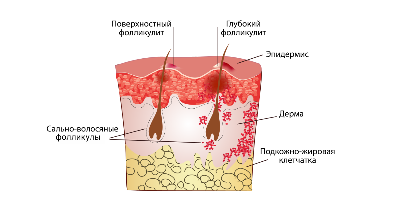 Фолликулит: причины возникновения, диагностика, лечение