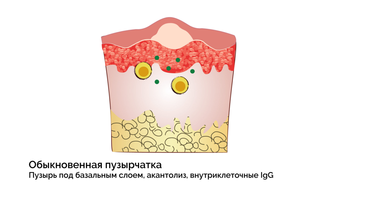 Пузырчатка В Полости Рта Фото