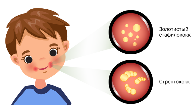 Стрептококковая инфекция: симптомы и лечение у детей и взрослых