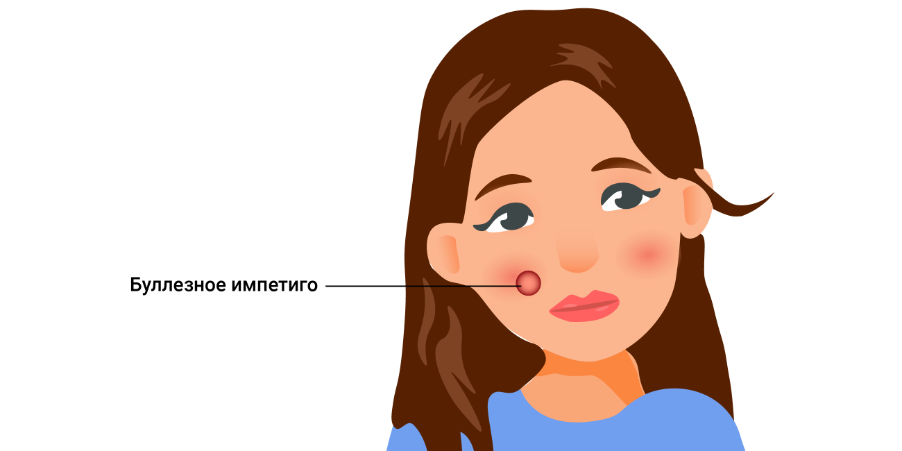 Импетиго: причины, виды, лечение, препараты и мази