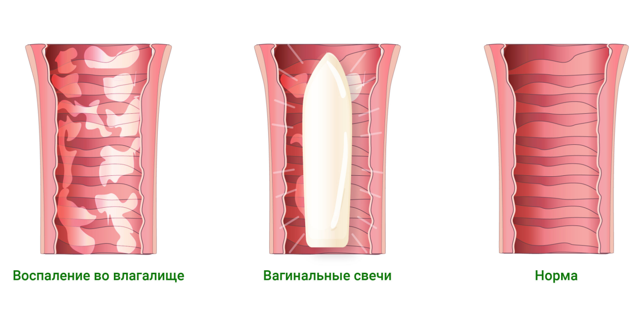 Чем отличается вагинит от. Вагинальные свечи вагинит. Бактериальный вагинит свечи.