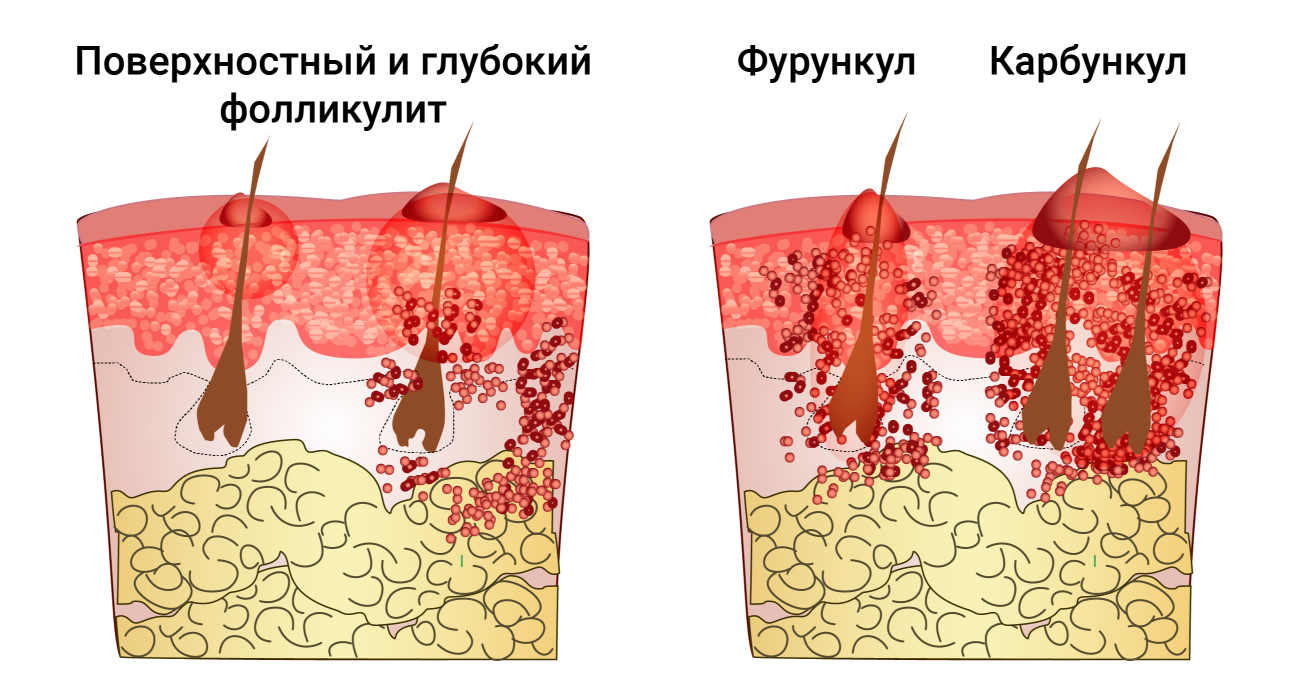 Пиодермия Кожи Фото