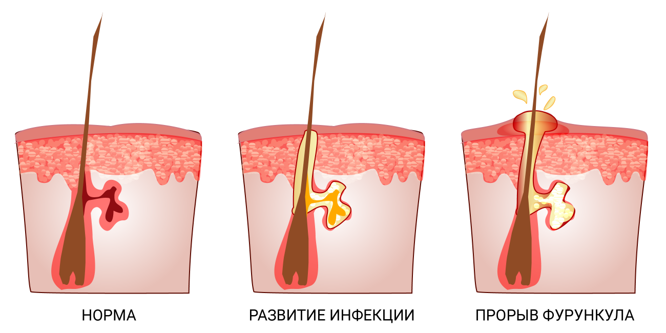 Карбункул - красивый, красный, драгоценный камень, но это совсем другая история.