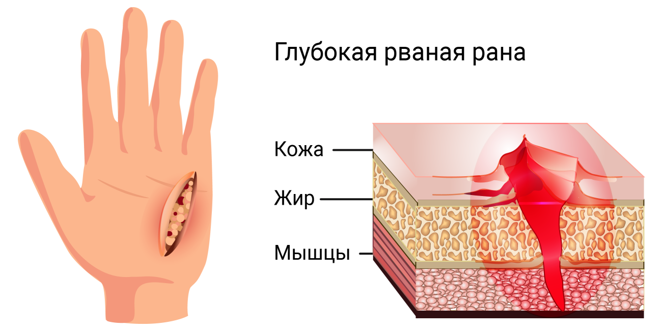 Раны причины