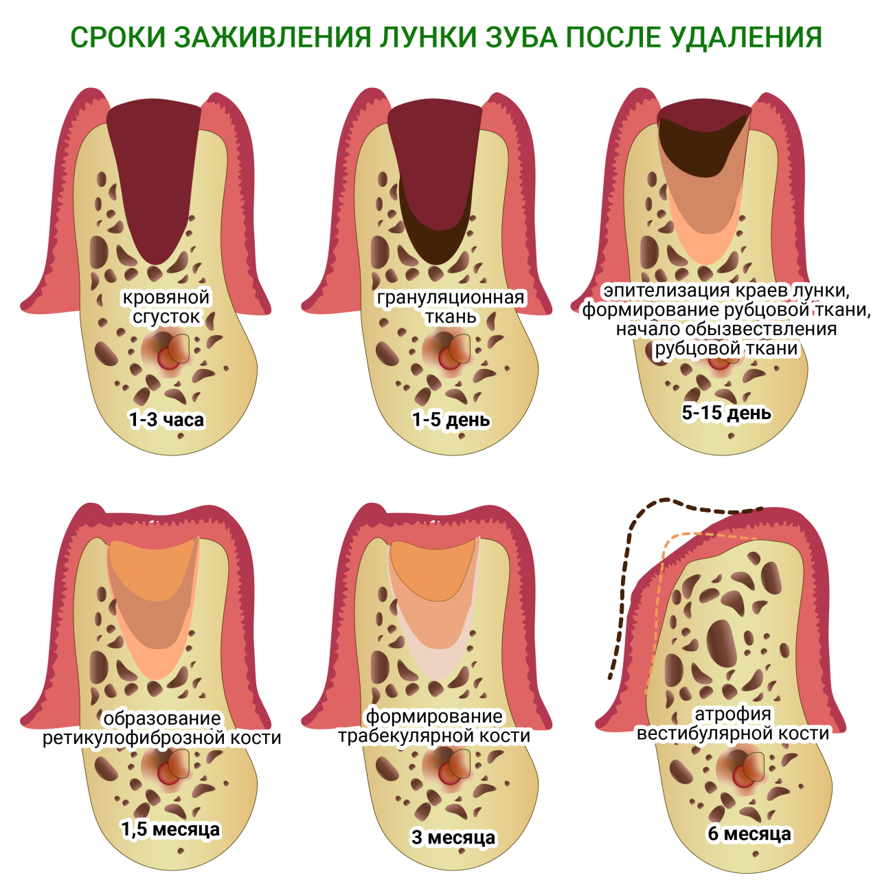 Удаление костной ткани зуба